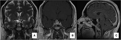 Ultrasound-guided endoscopic endonasal resection of sellar and suprasellar craniopharyngiomas